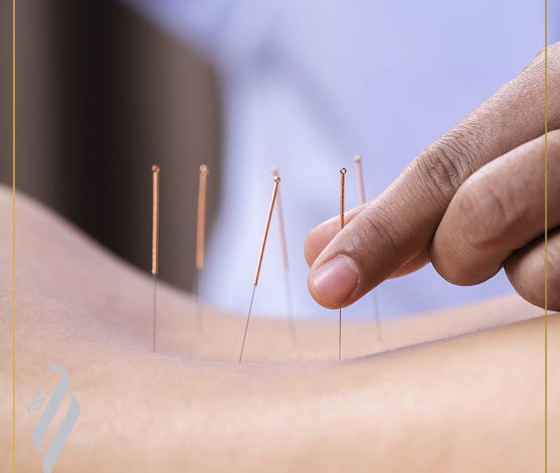 Acupuntura